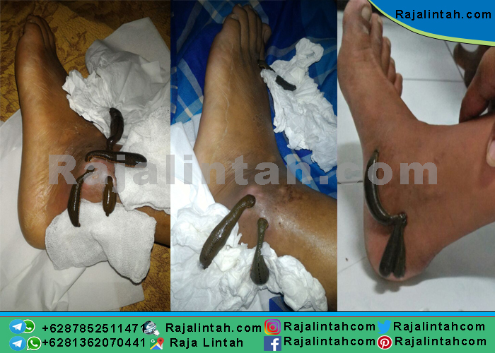 manfaat terapi lintah untuk diabetes