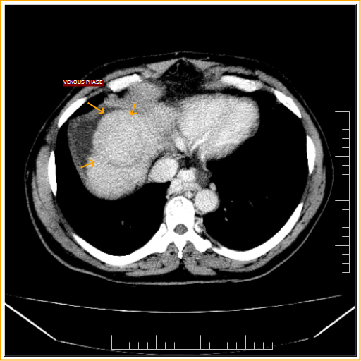 Hepatocellular carcinoma-CT - Sumer's Radiology Blog
