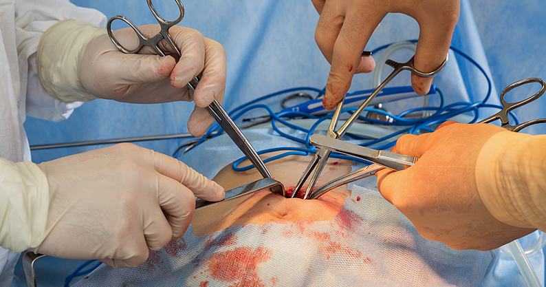 Dangerous Gastric Bypass Surgery Complications Every One