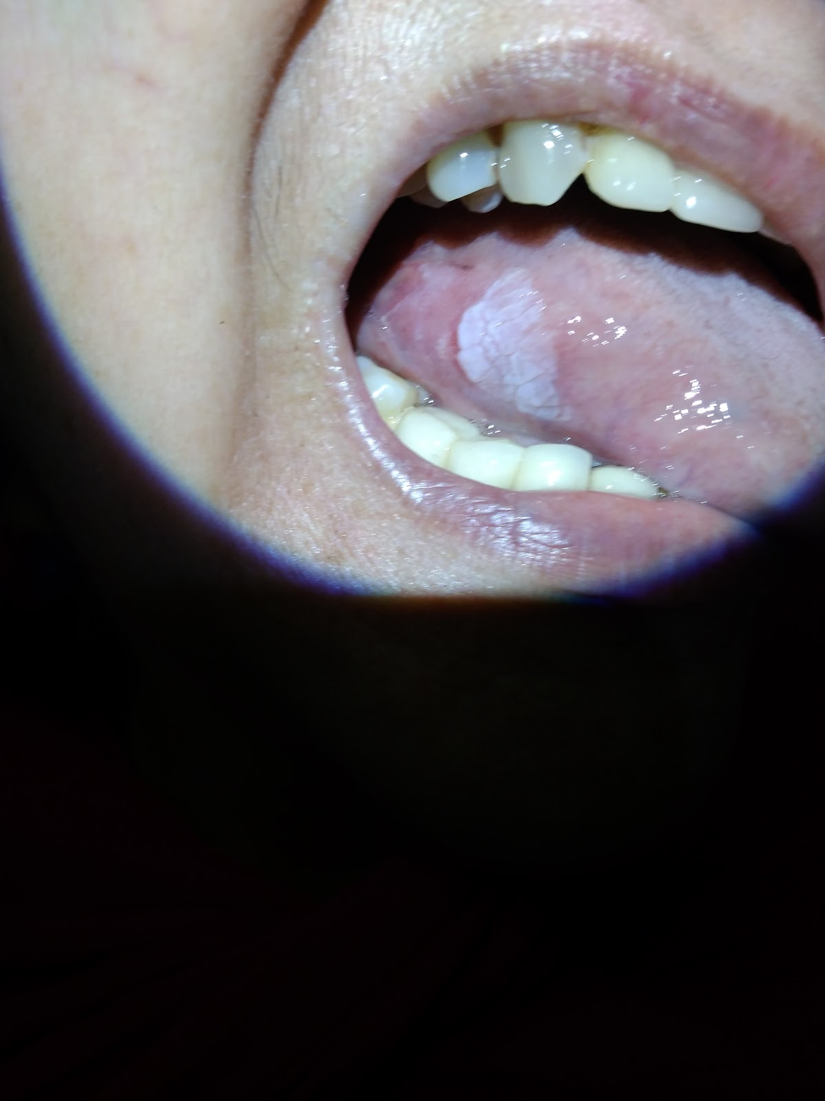 ENT Surgeon's blog Laser excision of Leukoplakia of the tongue