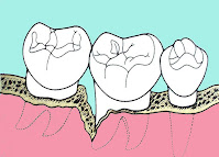<Img src ="Esquema-bolsa-periodontal.jpg" width = "200" height "144" border = "0" alt = "Ilustración de una bolsa periodontal .">