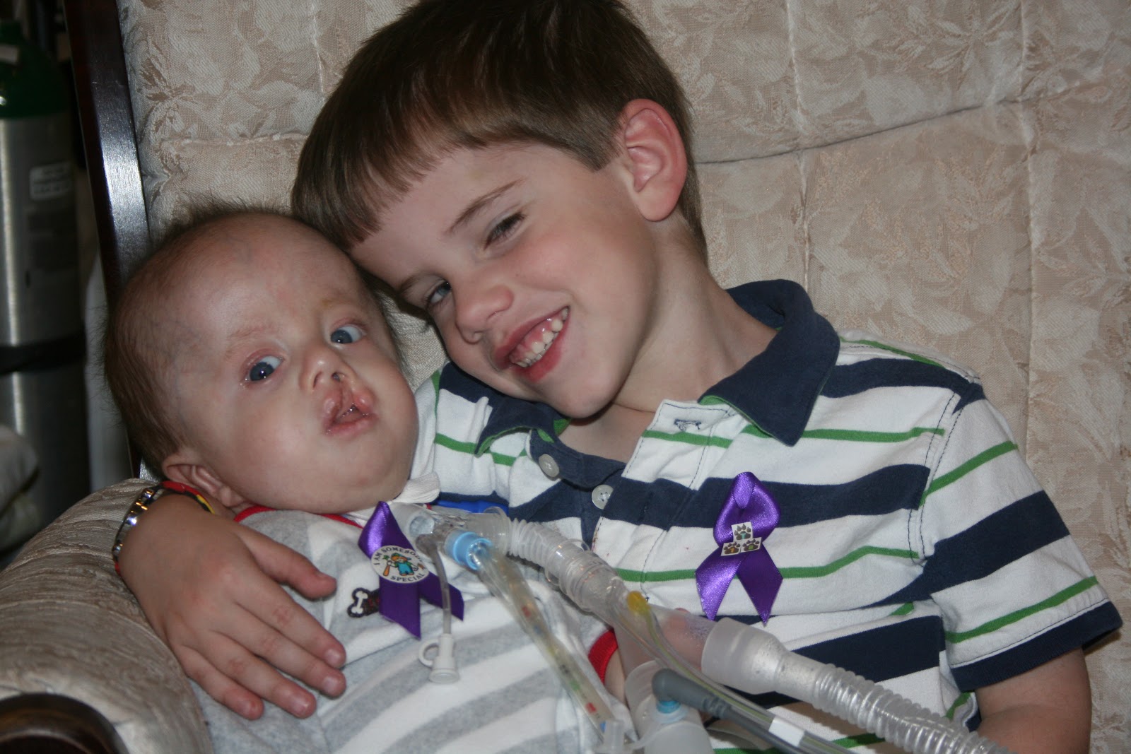 trisomy-pictures