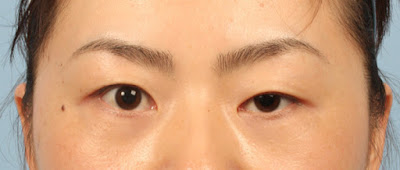 Phương pháp điều trị sụp mắt hiệu quả
