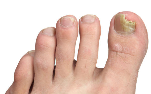 How To Cure Jock Itch
