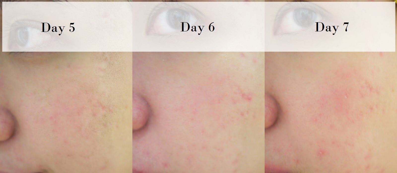 best skin resurfacing carbon fractional co2 laser treatment me aesthetic clinic time square kl review