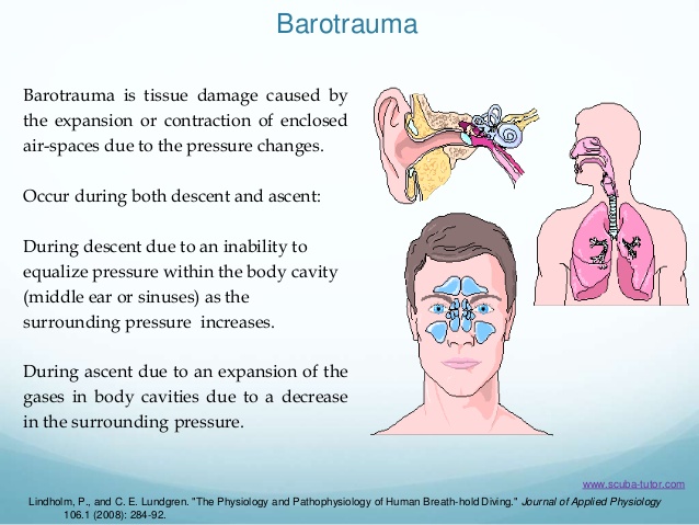 caisson disease