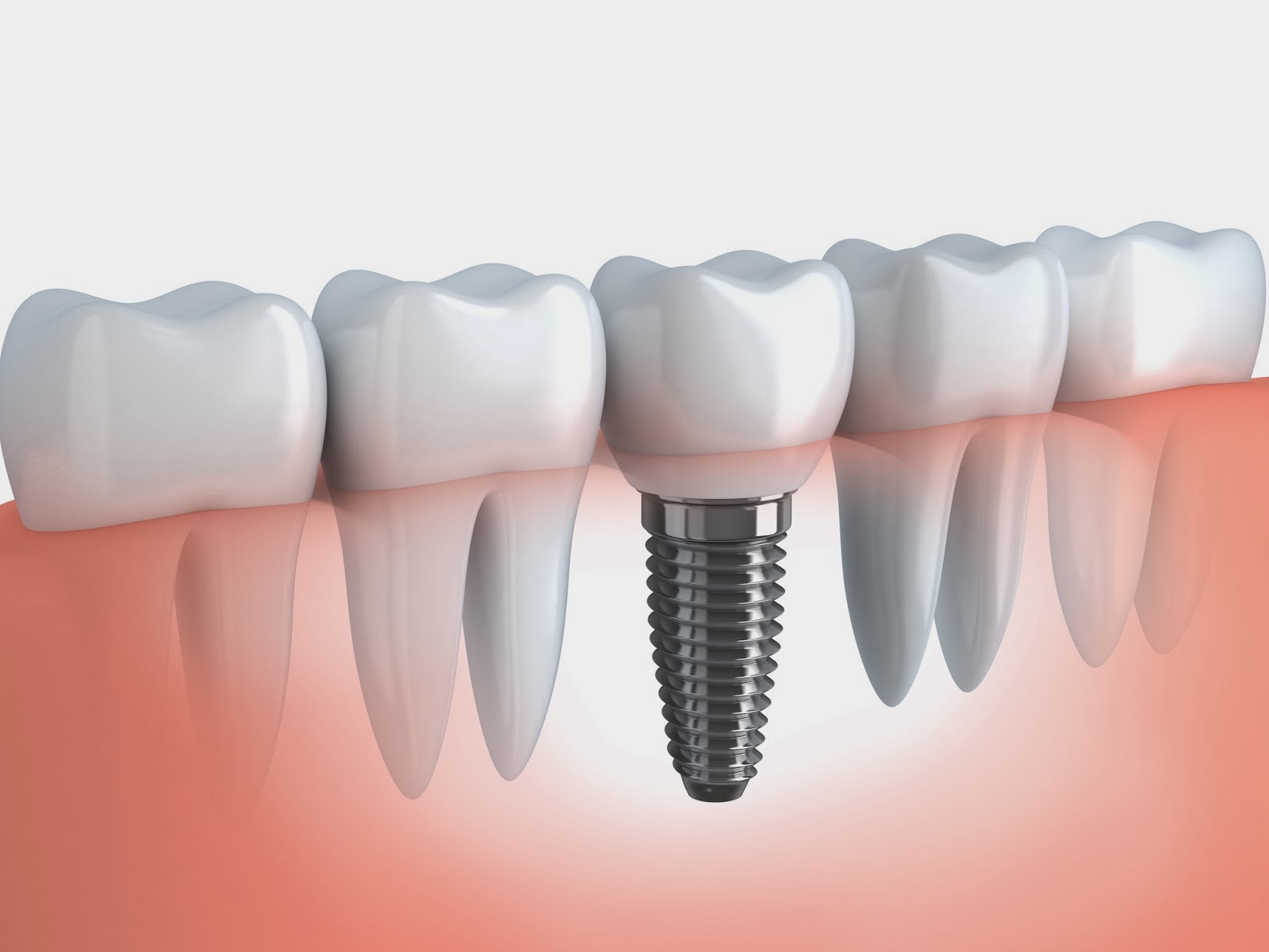Dentist, Brampton, Brampton Dental Implants, Implant Specialists, 