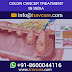 Colon Cancer Treatment & Surgery: What should You Know?