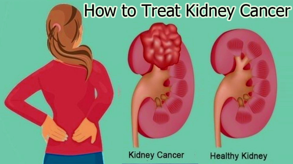 How to Treat Kidney Cancer