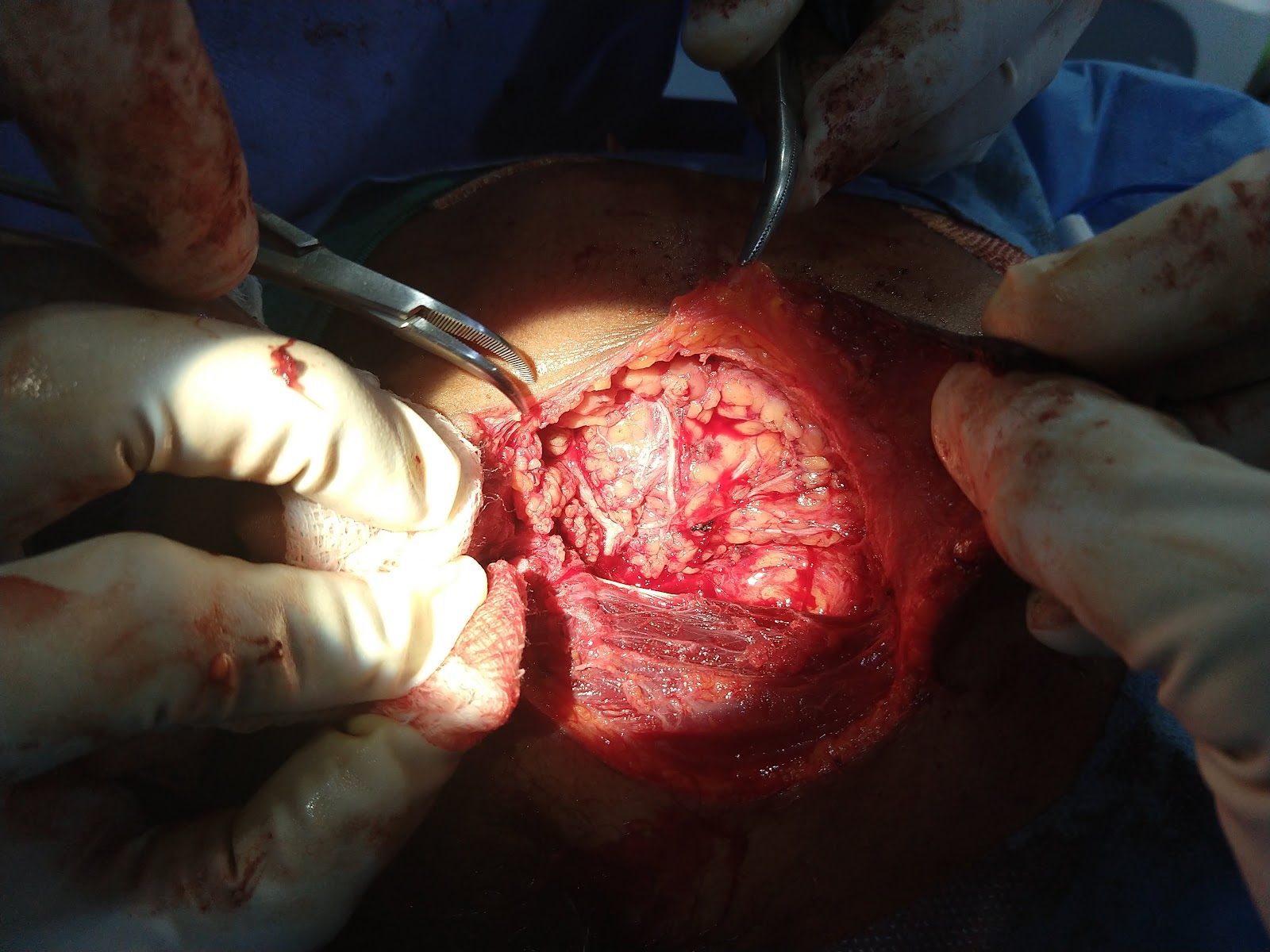 parotidectomy