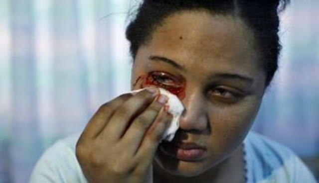 Hematidrosis, Penyakit Langka yang Membuat Penderita Akan Keluarkan Keringat dan Air Mata Darah Hematidrosis, Penyakit Langka yang Membuat Penderita Akan Keluarkan Keringat dan Air Mata Darah