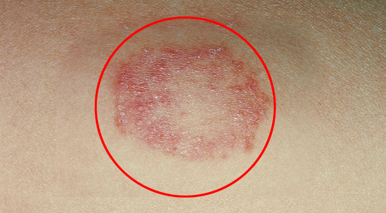 Ringworm skin infection, jock itching