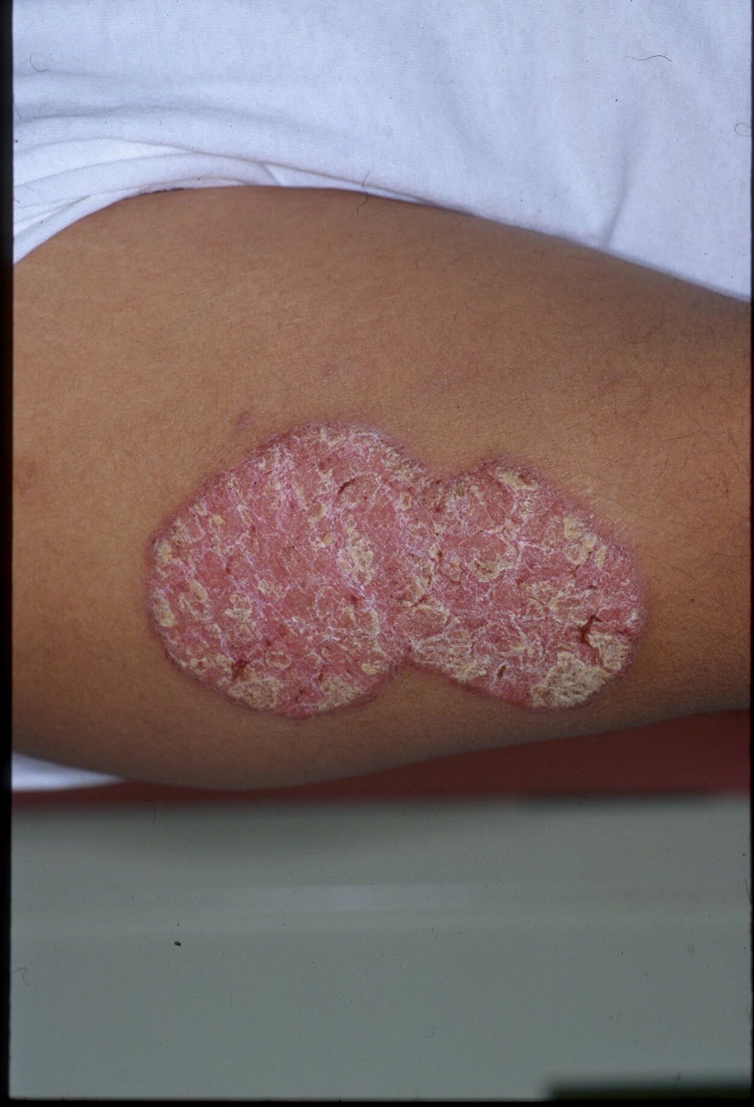 HEALTH FROM TRUSTED SOURCES Psoriasis