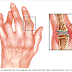 5 Tips Untuk Mengobati Artritis Anda