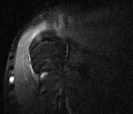 MedView Medical Imaging Consultancy Info Page: Motion artifact on MRI