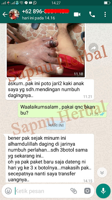 Obat Cantengan Bernanah / Jempol Kaki Bernanah & Bengkak ...