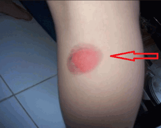 Cara menghilangkan luka bakar secara alami Cara menghilangkan luka bakar secara alami