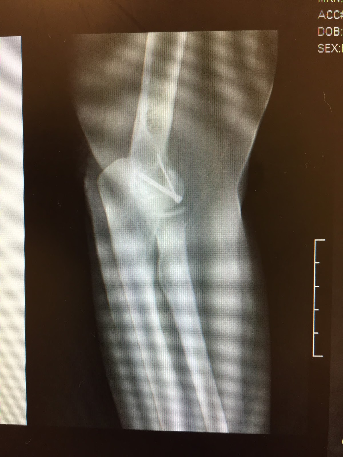 shoulder-and-elbow-surgery-shear-fractures-of-the-capitellum