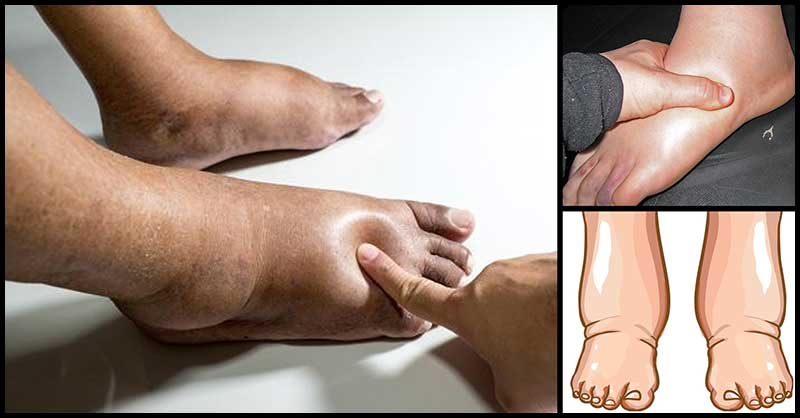 Reasons Behind Our Swollen Legs Ankles And Feet Dr Farrah Md
