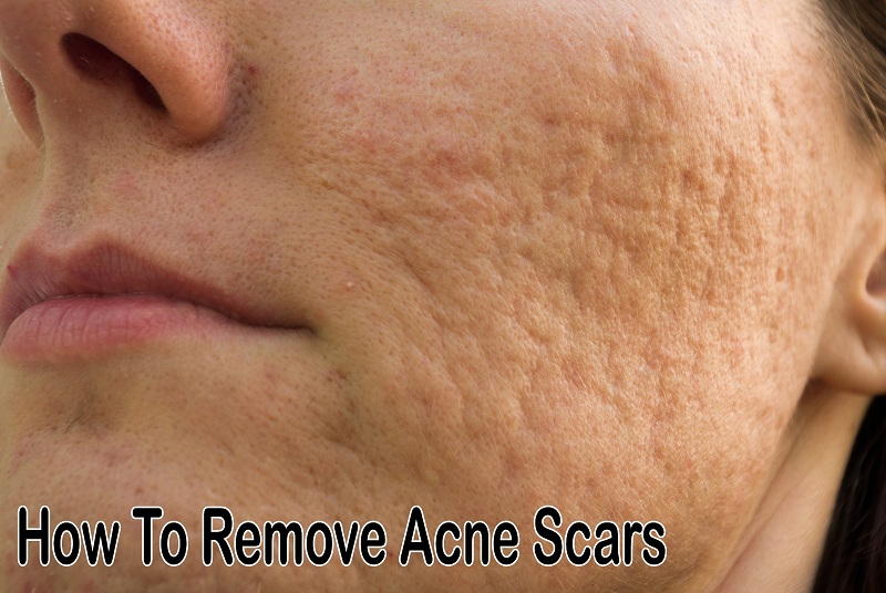 How to Remove Acne Scars Fast At Home Online Shopping