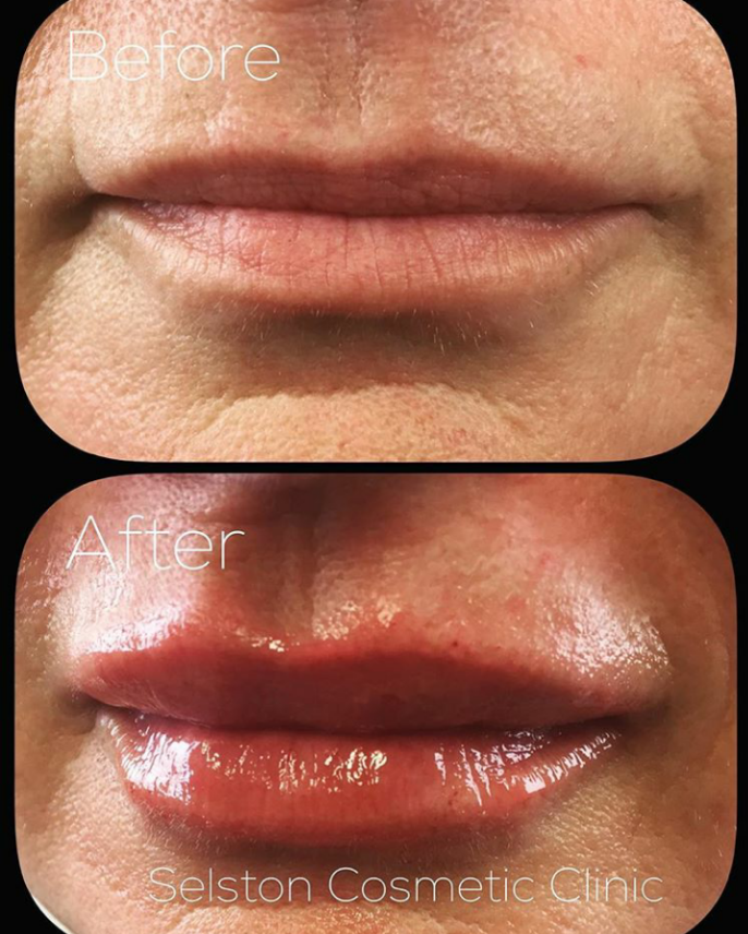 Selston Cosmetic Clinic Enhance Your Lips With Dermal Filler