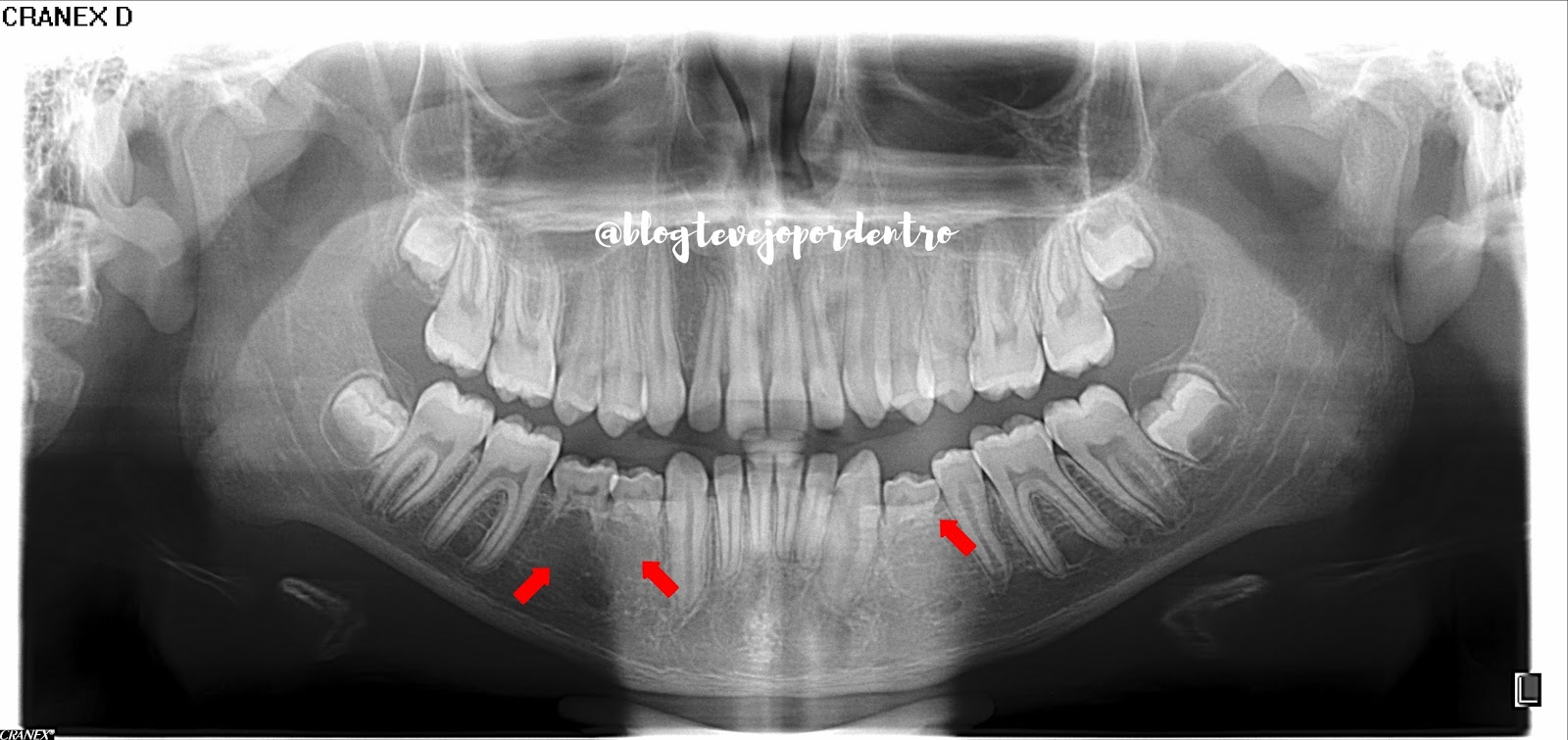 radiografía de agenesia dental