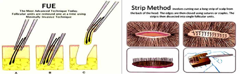 Методы пересадки волос. Трансплантация волос методом fue. Трансплантация волос стрип-методом (strip). Стрип метод трансплантации волос. Fue метод пересадки волос.