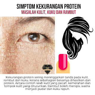 8 Simptom Kekurangan Protein 8 Simptom Kekurangan Protein