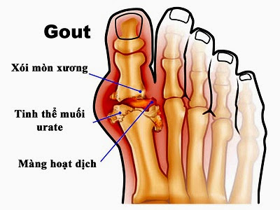 bệnh Goutt, bạn sẽ làm gì, đi những đâu.... Bệnh GOUT