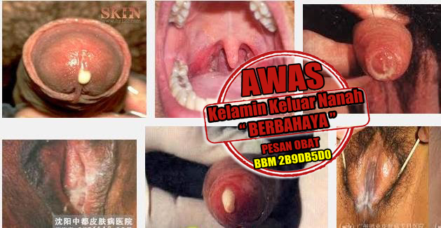 Cara Pencegahan Kencing Nanah Cara Pencegahan Kencing Nanah