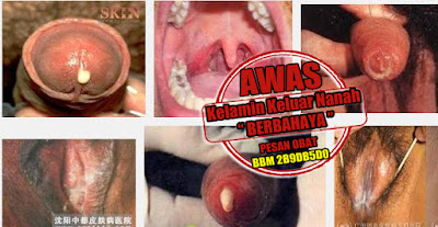 Obat Herbal Untuk Mengobati Kencing Sakit Keluar Nanah Obat Herbal Untuk Mengobati Kencing Sakit Keluar Nanah