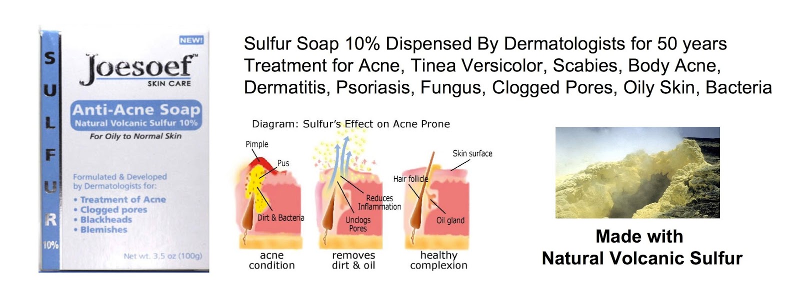 sulfur soap for pimples