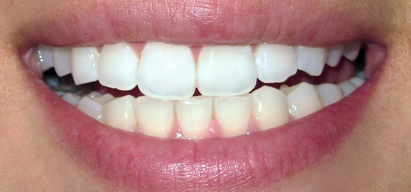 Be Linspired: How To Whiten Your Teeth At Home