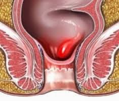 gambar wasir internal wasir intermal, wasir dalam, wasir setadium satu, wasir setadium 2, wasir setadium, 3
