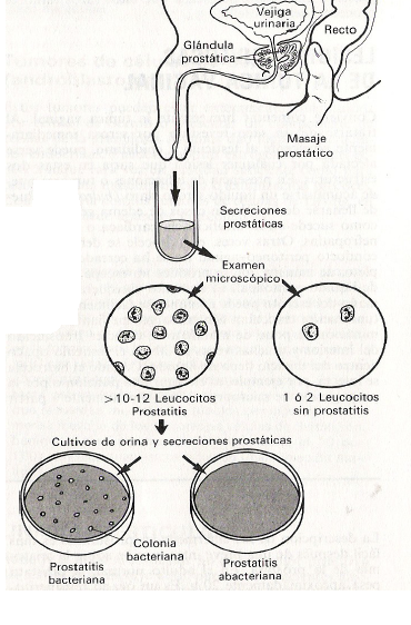 prostatitis no bacteriana no pasa ganancias