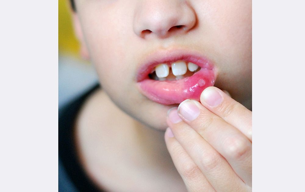 ORAL HEALTH Why does my young child keep having mouth ulcers