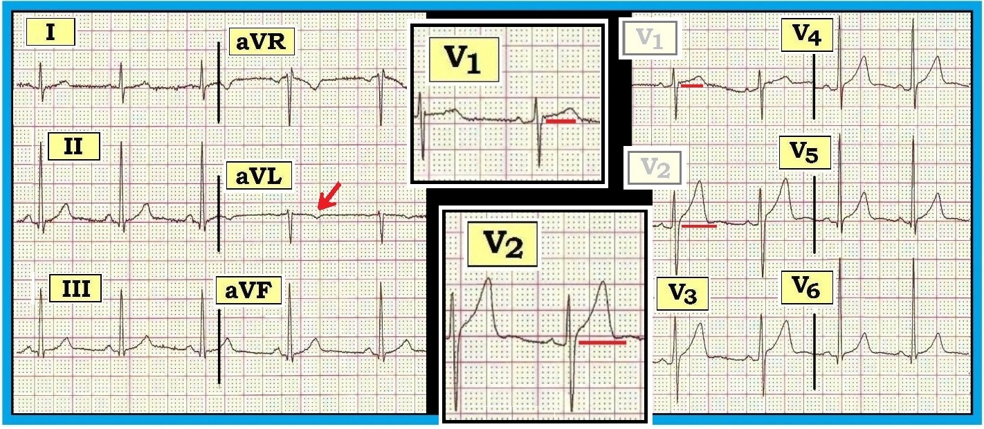ECG Interpretation: ECG Interpretation Review #47 (Normal Variants ...