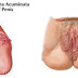 , Obat Kutil Kelamin Di Apotik thumbnail