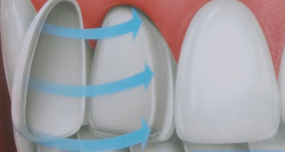 Phương pháp bọc răng sứ Veneer có hiệu quả không ?