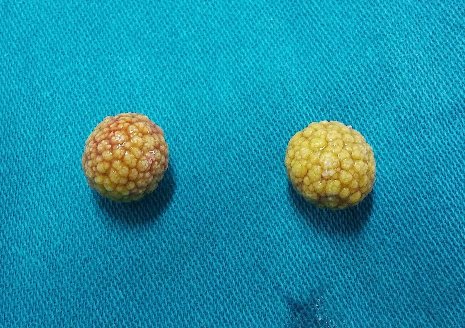 Polipos vesiculares tratamiento natural