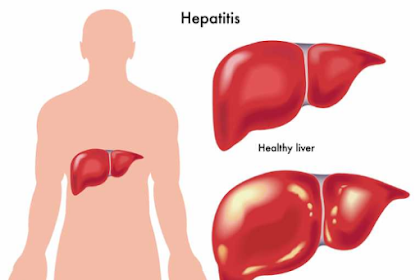 Penyebab Dan Tanda-Tanda Hepatitis