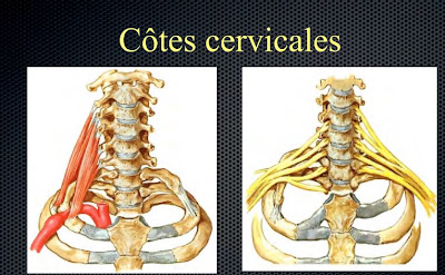 Cote Cervicale Hypertrophique – Côte Cervicale Surnuméraire – YTXPJ