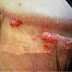 Gambar Kutil Di Alat Kelamin thumbnail