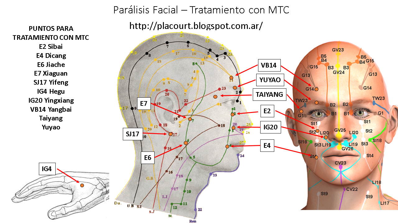 Puntos Motores De La Cara En Paralisis Facial