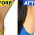 How to brighten dark armpits