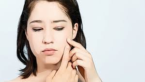 6 All-Natural Tips To Help Banish Your Acne - Beauty Tips Skin care 6 All-Natural Tips To Help Banish Your Acne - Beauty Tips Skin care