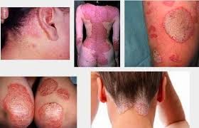 Obat Eksim Manjur Obat Eksim Manjur