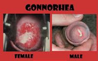 Obat Antibiotik Kencing Nanah/Gonore Paling Ampuh Saat Ini Obat Antibiotik Kencing Nanah/Gonore Paling Ampuh Saat Ini