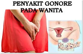 Penyakit Gonore