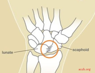 Cara Mengobati Pergelangan Tangan Yang Keseleo